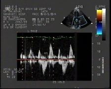 Heart troubles of Ramchand Yavathmal Tiruchinapalli Azamghar