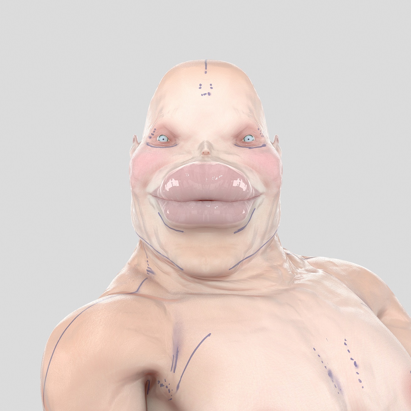 Caterpillarplasty